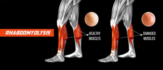 rabdomiolisis musculos